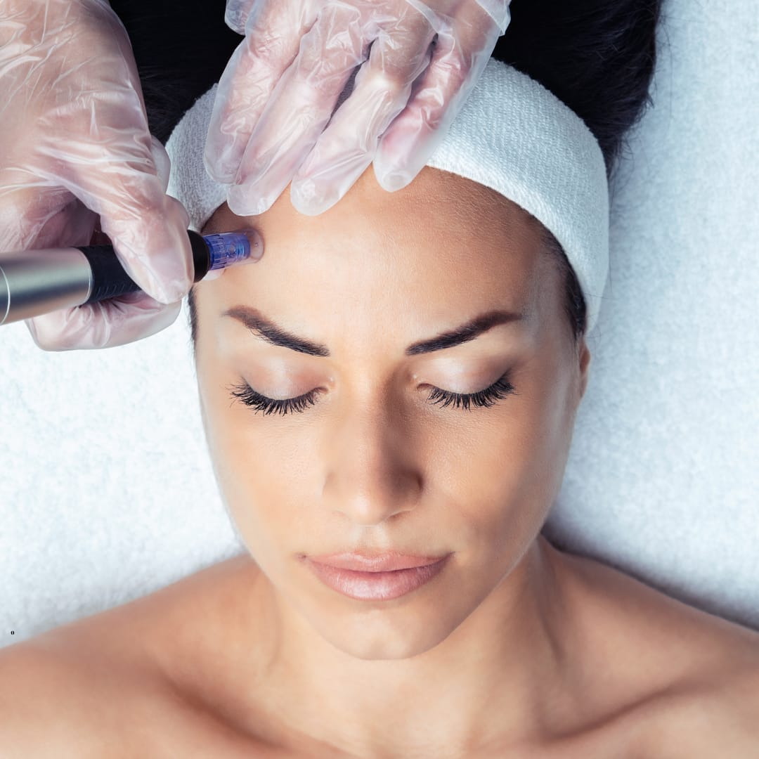 MICRONEEDLING FM BEAUTY LAB